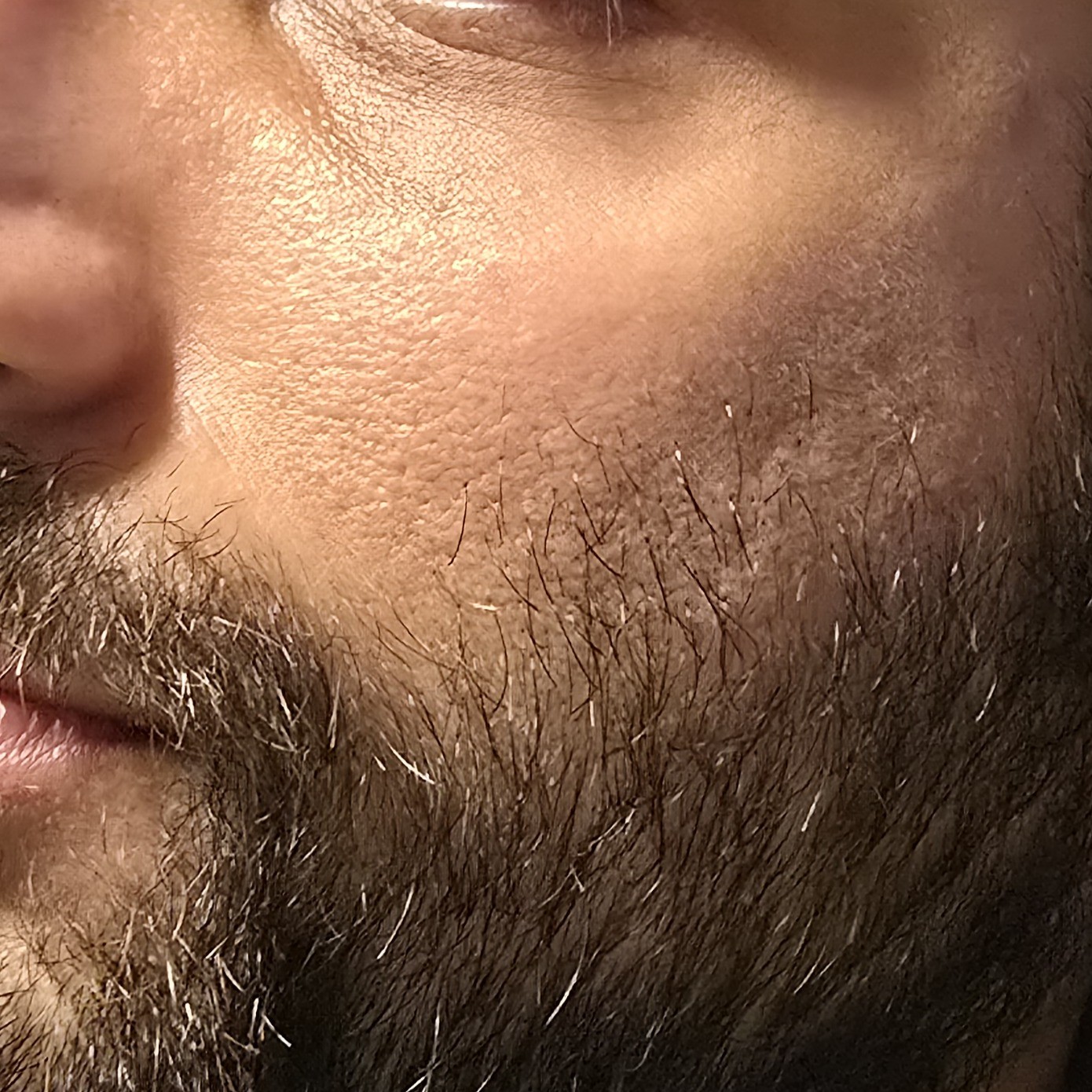 Fine lines before using Mary&May PDRN cream