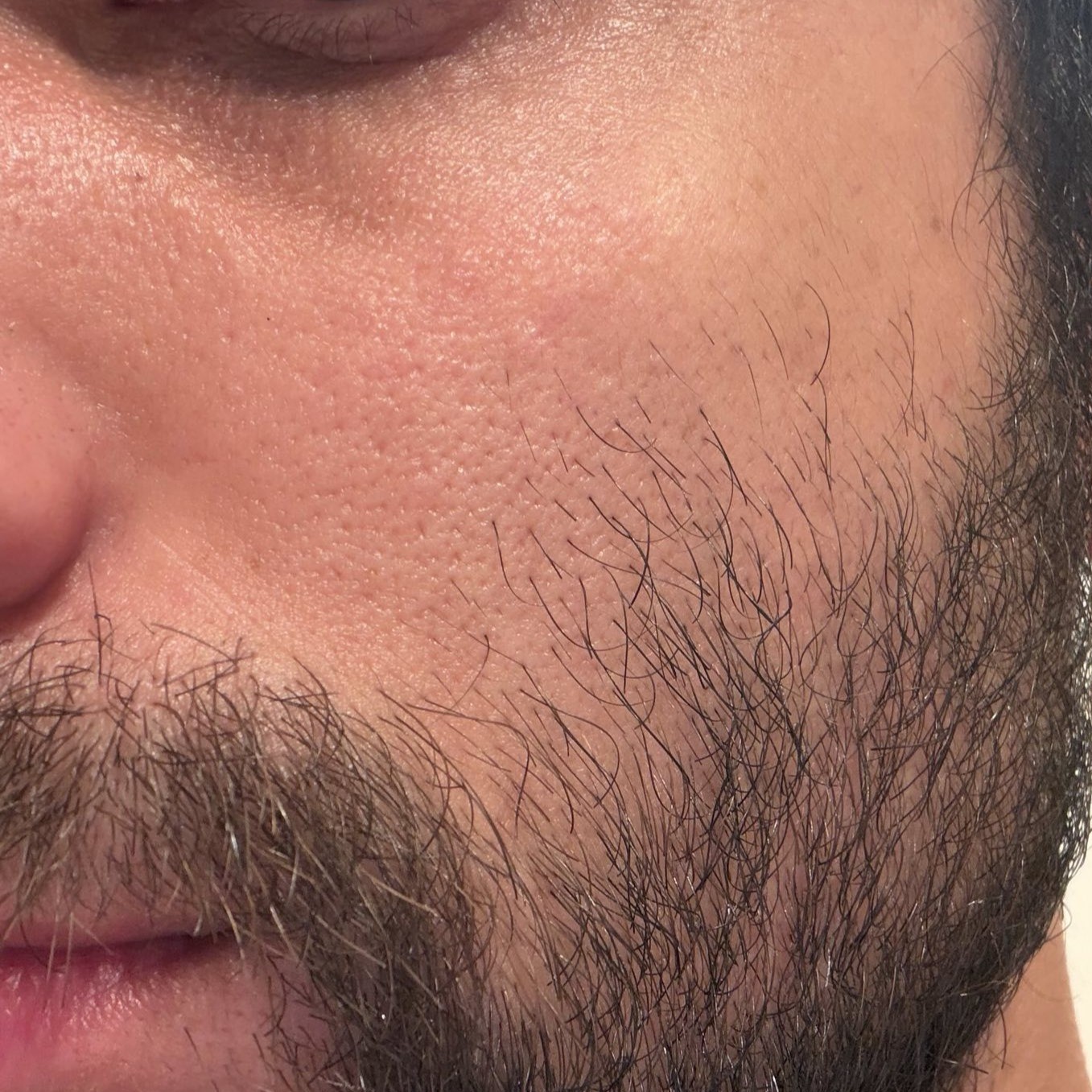 Cheek before using Sungboon Editor Silk Ampoule