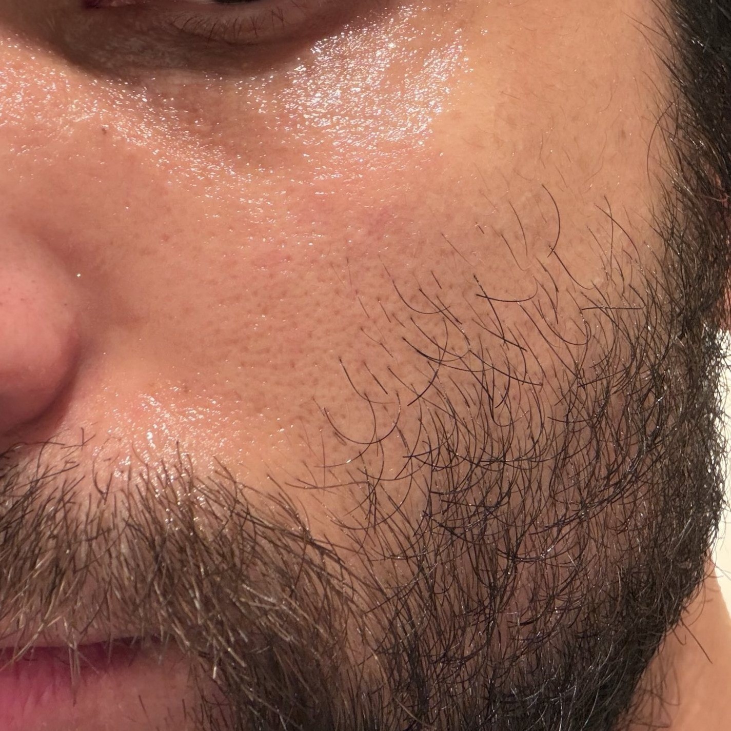 Cheek after using Sungboon Editor Silk Ampoule