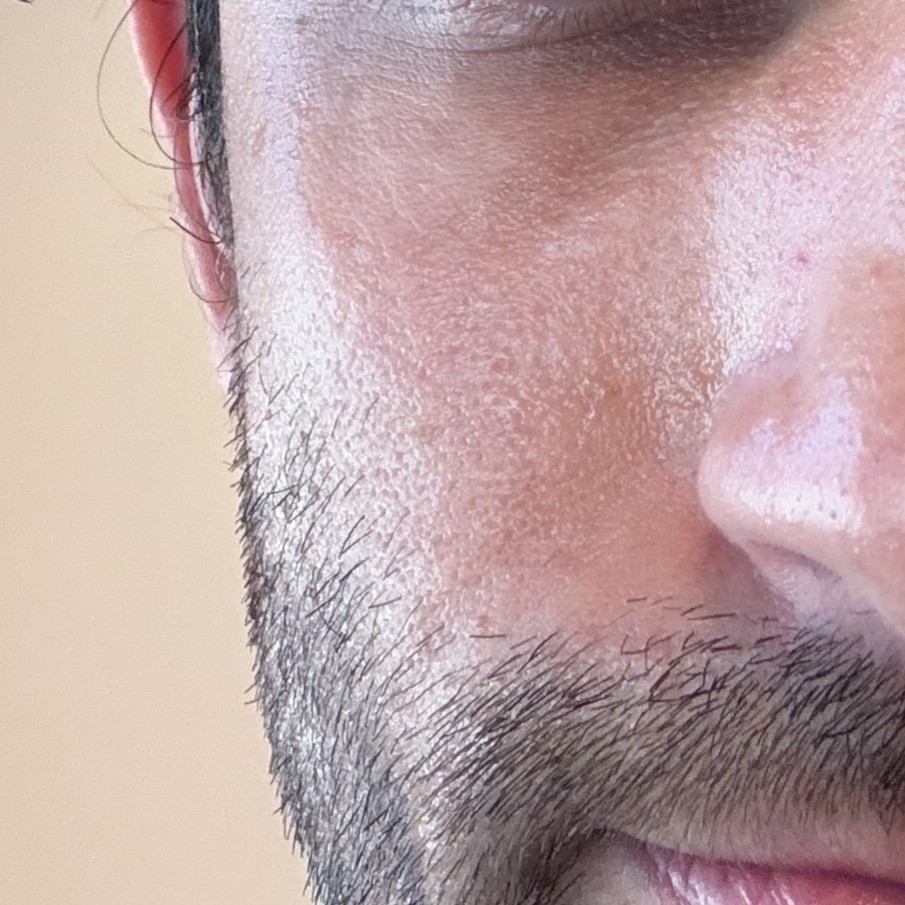 Skin after using Dr Reju-All Advanced PDRN Cream