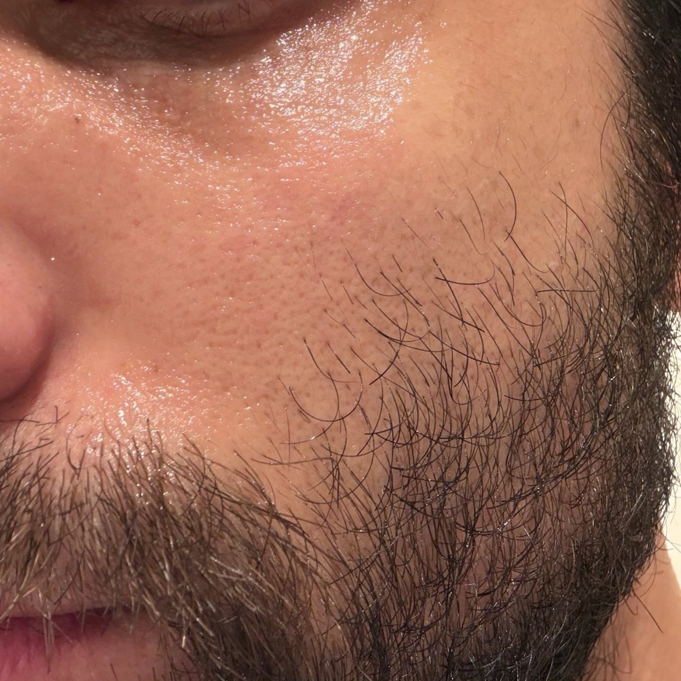 Fine lines after using Mary&May PDRN cream